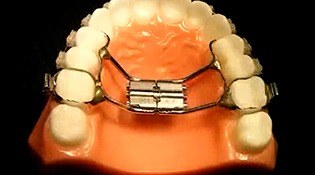 Model smile with palatal expanders