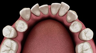 Top-view illustration of crowded, overlapping teeth