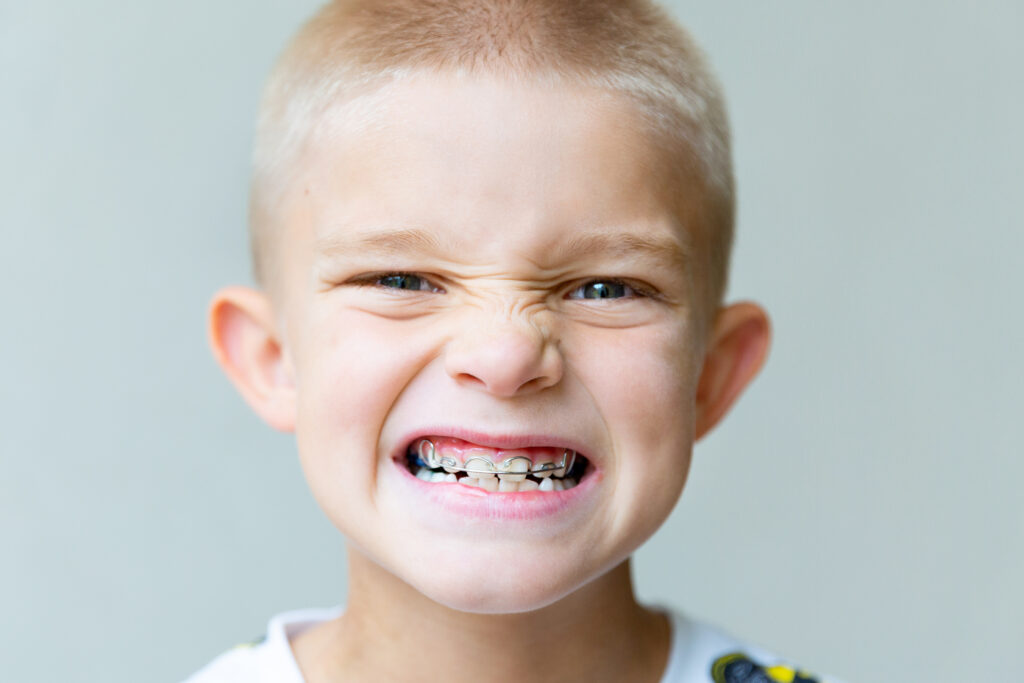 Young patient with Phase 1 orthodontics